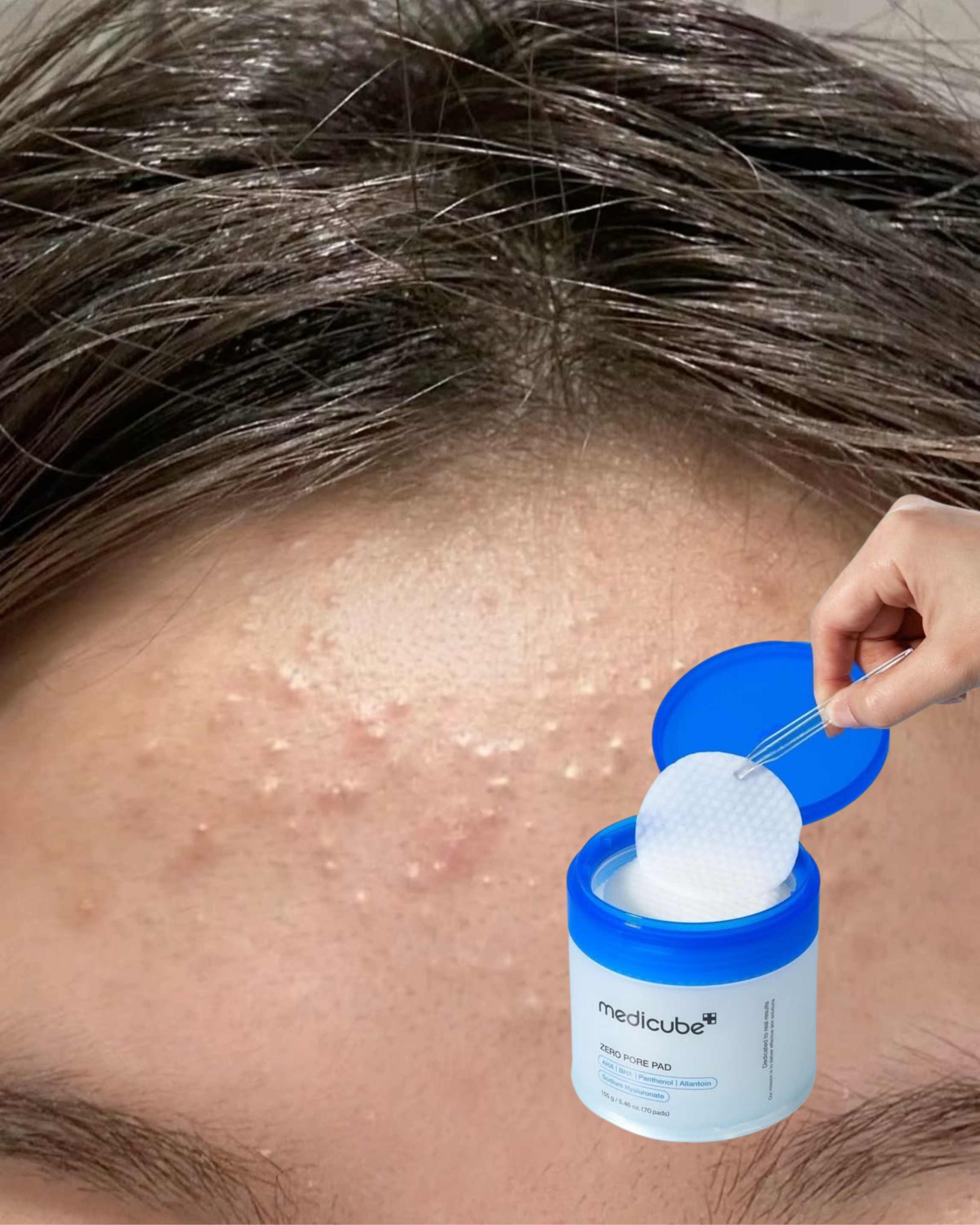 Petits boutons sur le front : comment s'en débarrasser ? Le guide en 2 étapes 🍓